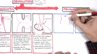 Bowel Obstruction - Causes and Pathophysiology