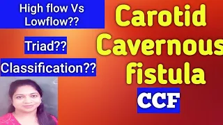 Carotid Cavernous Fistula/ CCF// HIGH FLOW Vs LOW FLOW// Classification//MBBS //Ophthalmology