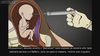 Хирургически аборт в трети триместър: Инжектиране и мъртво раждане