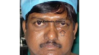 Orbitotomy Surgery Orbital Tumor Removal Mumbai India | Dr. Debraj Shome