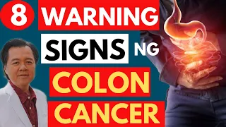 8 Warning Signs ng Colon Cancer - Tips by Doc Willie Ong (Internist and Cardiologist)#1081b
