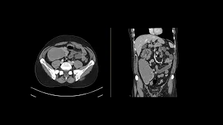 Large bowel Intussuception