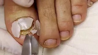 Fungal Nail with Dried Abscess 🦶 Ingrown Nail Treatment 🦶 Thick Fungal Toenail