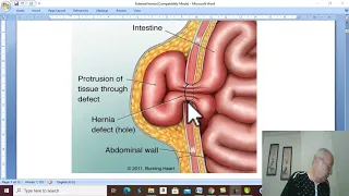 Hernia in Arabic 2 ( External Abdominal Hernia , part 1 ) , by  Dr.Wahdan