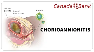 Chorioamnionitis