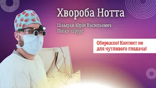 Хвороба Нотта