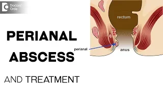 What is perianal abscess and its treatment? - Dr. Prashanth Varadaraju