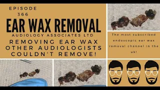 REMOVING EAR WAX THE OTHER AUDIOLOGISTS COULDN'T REMOVE  EP 366