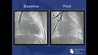 Tendyne Transcatheter MVR: Global Feasibility Results - Paul Sorajja, MD