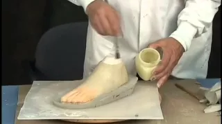 Custom Fabrication of A Silicone Partial Foot Prosthesis