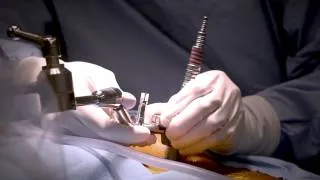 Minimally Invasive Laminectomy Surgery to Treat Lumbar Stenosis - MedStar Southern Maryland