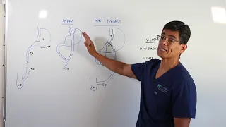 Mini Gastric Bypass Procedure - Dr. Mario del Pino