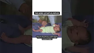 The Moro (STARTLE) Reflex in an Infant
