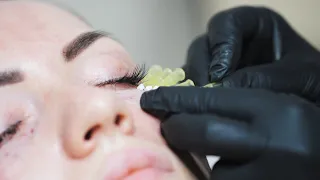 Видео установки нитей в периорбитальной области глаз и по спинке носа