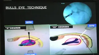 Dr. S. K. Pal - PCNL Puncture Fluroscopic Triangulation Technique