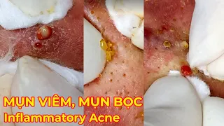 Điều trị mụn bọc, mụn viêm hiệu quả tại TPHCM | Hiền Vân spa | Cyst Acne Treatment | 690