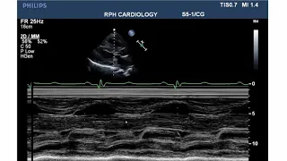 LVOT Obstruction