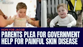 Parents Plea For Government Help For Painful Skin Disease