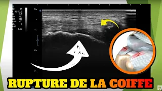 Echographie d'une rupture de la coiffe des rotateurs