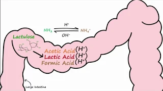 Hepatic Encephalopathy and Lactulose