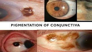 PIGMENTATIONS OF CONJUNCTIVA . Are they cancerous?