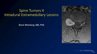 Spine tumors 4 – Intradural Extramedullary Lesions