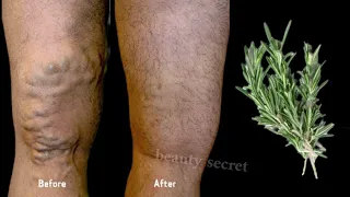 unbelievable! Get rid of varicose veins with rosemary, this treasure should be in every home.