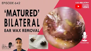 642 - 'Matured' Ear Wax Removal