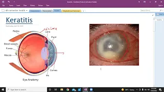 Keratitis | types of keratitis | Ophthalmology | USMLE step 1