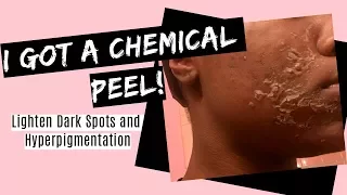 My Chemical Peel Experience- Vitalize Peel | Very Detailed Before and After