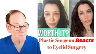 Plastic Surgeon Reacts | Lorry Hill's Blepharoplasty Before & After