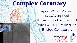 PCI of Proximal LAD/Diagonal Bifurcation Lesions & mid LAD CTO filling w Bridge Collaterals May 2014