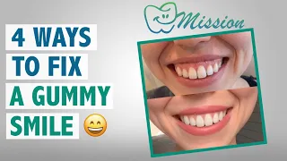 Do you show too much gums when you smile? Learn how it can be fixed