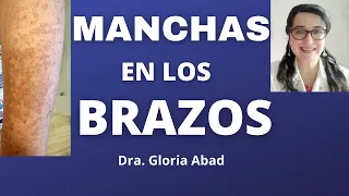 MANCHAS EN LOS BRAZOS (y ESTAS BEBIDAS pueden estar MANCHANDO TU PIEL) 😱