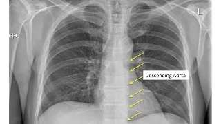 Chest X-ray Intro and Approach