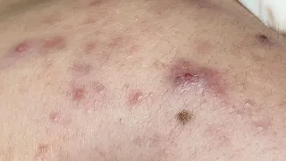 Acne Treament Under The Skin #069