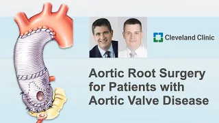 Valve Sparing Aortic Root Replacement: Surgeon Roundtable with Dr. Roselli and Dr. Koprivanac