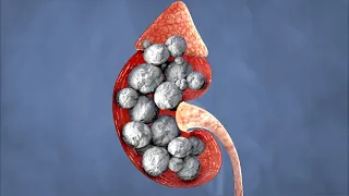 A Student Ate 108 Gummy Antacids For Breakfast. This Is What Happened To Her Kidneys.