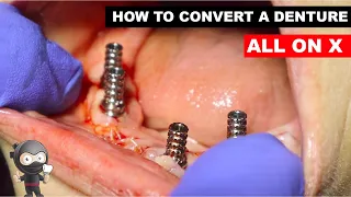 How to Convert All on X Denture