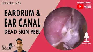 698 - Eardrum & Ear Canal Dead Skin Peel