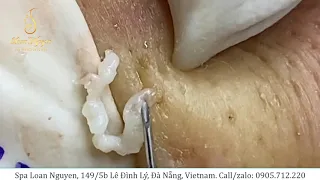 Removing large cysts for boys and whiteheads extraction (233) | Loan Nguyen