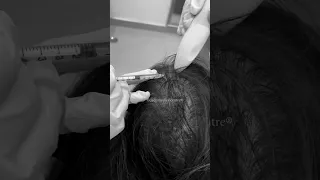 The Ultimate Solution For Hair Regrowth | Hair Transplant Clinic  | Dadu Medical Centre