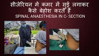 सीजेरियन में कमर में सुई लगाकर कैसे बेहोश करते हैं / Spinal Anaesthesia in C- Section / OT Recording