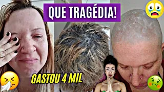 MEGAHAIR COM FUNGOS E FERIDAS NO COURO CABELUDO! ELA TEVE QUE RASPAR A CABEÇA!!! CUIDADO!!