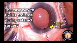 easy way to fix iris prolapse during cataract surgery