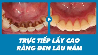 Review quá trình lấy cao răng đen lâu năm của anh Quang | Nhakhoaoze.com