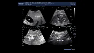 Stone at PUJ and two ureteric stones.