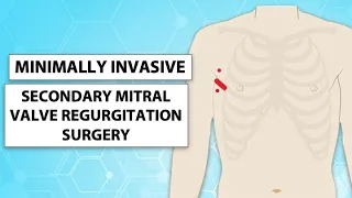 Surgeon Q&A: Minimally-Invasive Surgery for Secondary Mitral Valve Regurgitation with Dr. Arghami