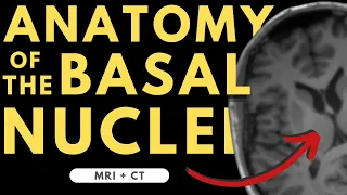 Basal ganglia (basal nuclei) neuroanatomy | Radiology anatomy part 1 prep | MRI + CT