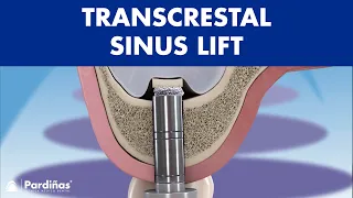 TRANSCRESTAL sinus lift - IMPLANT placement for BONELESS patients ©